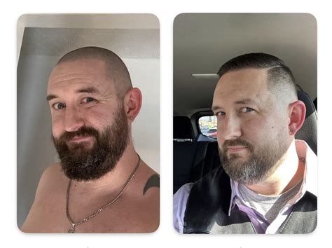 mpb by choice 4|Thinking of permanently destroying the hairline Currently.